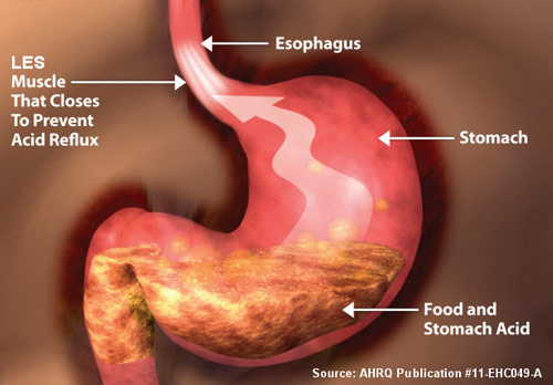 Acid Reflux & GERD Treatment